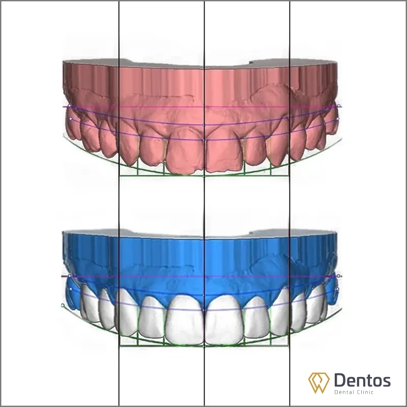 Công nghệ DSD thiết kế nụ cười nhiên và hài hòa